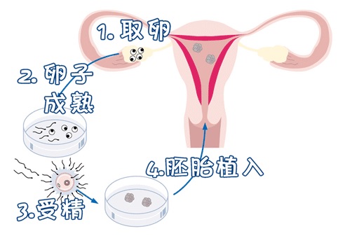 无精症